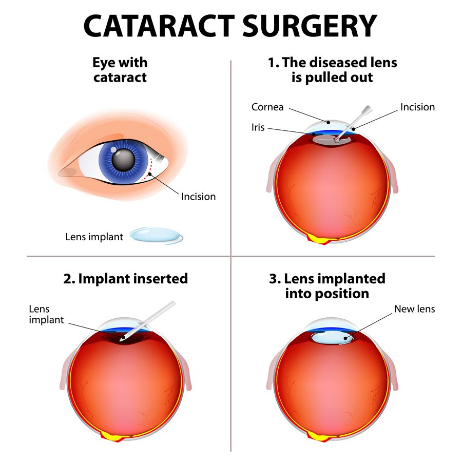 Cataract Surgery Entegrity